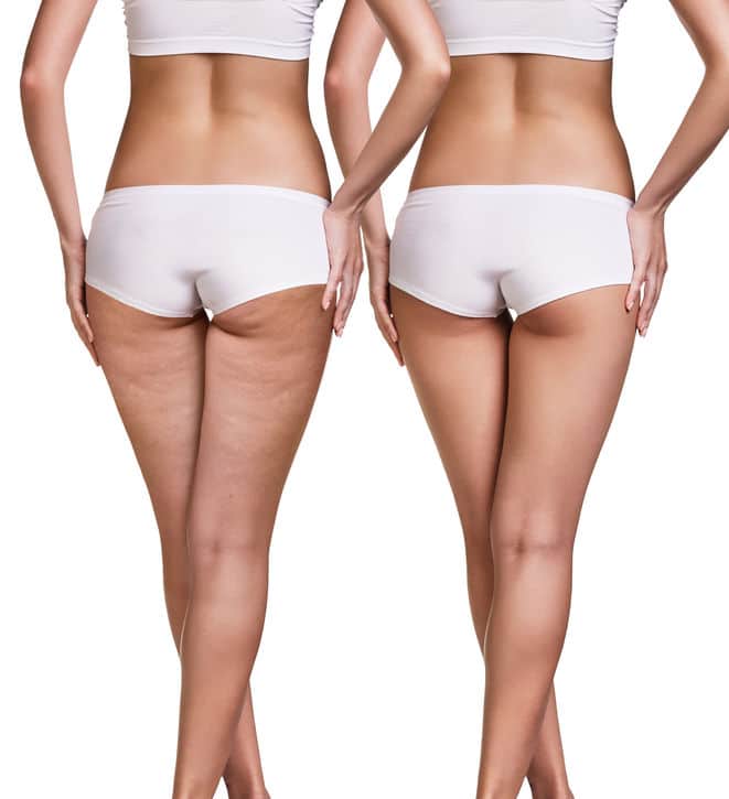 cellulite-femmes